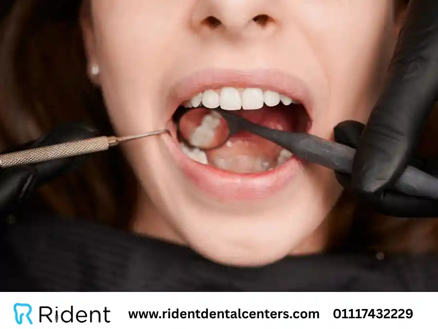 كيف أزيل تسوس الأسنان بـ 3 طرق؟